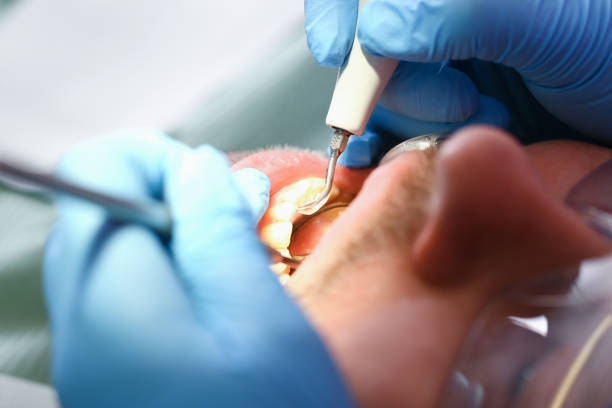 Best Dental Abscess Treatment in Cornell, WI